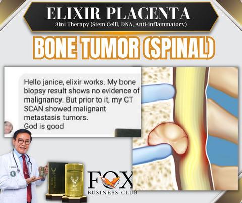 elixir placenta store Bone Tumor(Spinal)